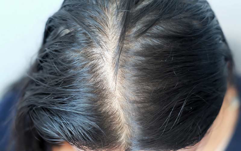 Can Oily Hair Cause Hair Loss An Easy Guide To Understand The Causes Of Oily Hair Loss Hair Guider